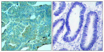 Immunohistochemical analysis of paraffin-embedded human colon carcinoma tissue using PKR(Phospho-Thr446) Antibody(left) or the same antibody preincubated with blocking peptide(right).Rabbit anti-Human EIF2AK2 Polyclonal Antibody