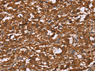 The image on the left is immunohistochemistry of paraffin-embedded Human thyroid cancer tissue using DCTN6 Antibody(DCTN6 Antibody) at dilution 1/60, on the right is treated with fusion protein. (Original magnification: ×200)Rabbit anti-Human DCTN6 Polyclonal Antibody