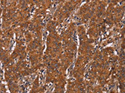 The image on the left is immunohistochemistry of paraffin-embedded Human gastic cancer tissue using the antibody Antibody) at dilution 1/60, on the right is treated with fusion protein. (Original magnification: ×200)Rabbit anti-Human DCTN6 Polyclonal Antibody
