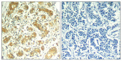 Immunohistochemical analysis of paraffin-embedded human breast carcinoma tissue using syk(Ab-323) Antibody(left) or the same antibody preincubated with blocking peptide(right).Rabbit anti-Human SYK Polyclonal Antibody