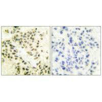 Immunohistochemical analysis of paraffin-embedded human breast carcinoma tissue using DNA-PK antibody.Rabbit anti-Human PRKDC Polyclonal Antibody