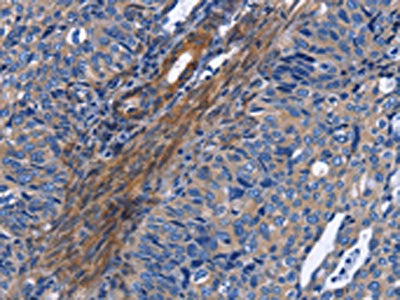 The image on the left is immunohistochemistry of paraffin-embedded Human cervical cancer tissue using NAT8 Antibody(NAT8 Antibody) at dilution 1/50, on the right is treated with fusion protein. (Original magnification: ×200)Rabbit anti-Human NAT8 Polyclonal Antibody