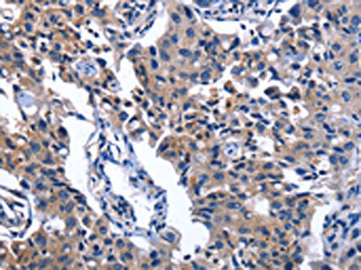 The image on the left is immunohistochemistry of paraffin-embedded Human lung cancer tissue using the antibody Antibody) at dilution 1/50, on the right is treated with fusion protein. (Original magnification: ×200)Rabbit anti-Human NAT8 Polyclonal Antibody