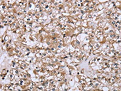 The image on the left is immunohistochemistry of paraffin-embedded Human prostate cancer tissue using FCAR Antibody(FCAR Antibody) at dilution 1/20, on the right is treated with fusion protein. (Original magnification: ×200)Rabbit anti-Human FCAR Polyclonal Antibody