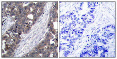 Immunohistochemical analysis of paraffin-embedded human breast carcinoma tissue using p70 S6 Kinase(Ab-411) Antibody(left) or the same antibody preincubated with blocking peptide(right).Rabbit anti-Human RPS6KB1 Polyclonal Antibody