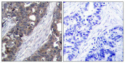 Immunohistochemical analysis of paraffin-embedded human breast carcinoma tissue using p70 S6 Kinase(Ab-411) Antibody(left) or the same antibody preincubated with blocking peptide(right).Rabbit anti-Human RPS6KB1 Polyclonal Antibody