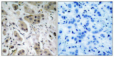 Immunohistochemical analysis of paraffin-embedded human breast carcinoma tissue using Akt(Phospho-Ser473) Antibody(left) or the same antibody preincubated with blocking peptide(right).Rabbit anti-Human AKT1 Polyclonal Antibody
