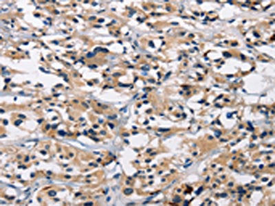 The image on the left is immunohistochemistry of paraffin-embedded Human thyroid cancer tissue using ARSB Antibody(ARSB Antibody) at dilution 1/50, on the right is treated with synthetic peptide. (Original magnification: ×200)Rabbit anti-Human ARSB Polyclonal Antibody