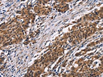 The image on the left is immunohistochemistry of paraffin-embedded Human gastic cancer tissue using the antibody Antibody) at dilution 1/50, on the right is treated with synthetic peptide. (Original magnification: ×200)Rabbit anti-Human ARSB Polyclonal Antibody