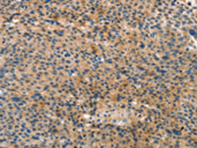 The image on the left is immunohistochemistry of paraffin-embedded Human liver cancer tissue using ANXA10 Antibody(ANXA10 Antibody) at dilution 1/35, on the right is treated with fusion protein. (Original magnification: ×200)Rabbit anti-Human ANXA10 Polyclonal Antibody