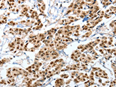 The image on the left is immunohistochemistry of paraffin-embedded Human breast cancer tissue using the antibody Antibody) at dilution 1/35, on the right is treated with fusion protein. (Original magnification: ×200)Rabbit anti-Human ANXA10 Polyclonal Antibody