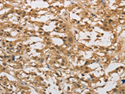 The image on the left is immunohistochemistry of paraffin-embedded Human thyroid cancer tissue using DAB2 Antibody(DAB2 Antibody) at dilution 1/30, on the right is treated with fusion protein. (Original magnification: ×200)Rabbit anti-Human DAB2 Polyclonal Antibody