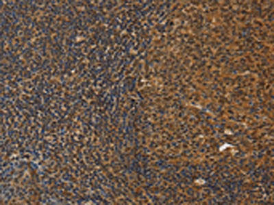 The image on the left is immunohistochemistry of paraffin-embedded Human tonsil tissue using the antibody Antibody) at dilution 1/30, on the right is treated with fusion protein. (Original magnification: ×200)Rabbit anti-Human DAB2 Polyclonal Antibody