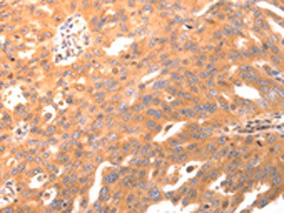 The image on the left is immunohistochemistry of paraffin-embedded Human ovarian cancer tissue using BDKRB2 Antibody(BDKRB2 Antibody) at dilution 1/30, on the right is treated with synthetic peptide. (Original magnification: ×200)