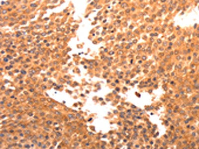 The image on the left is immunohistochemistry of paraffin-embedded Human breast cancer tissue using the antibody Antibody) at dilution 1/30, on the right is treated with synthetic peptide. (Original magnification: ×200)