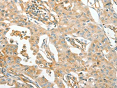 The image on the left is immunohistochemistry of paraffin-embedded Human lung cancer tissue using ACE Antibody(ACE Antibody) at dilution 1/70, on the right is treated with synthetic peptide. (Original magnification: ×200)