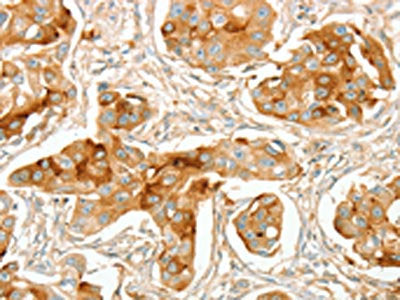 The image on the left is immunohistochemistry of paraffin-embedded Human breast cancer tissue using the antibody Antibody) at dilution 1/70, on the right is treated with synthetic peptide. (Original magnification: ×200)