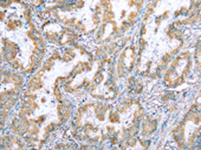 The image on the left is immunohistochemistry of paraffin-embedded Human esophagus cancer tissue using VAPA Antibody(VAPA Antibody) at dilution 1/35, on the right is treated with fusion protein. (Original magnification: ×200)Rabbit anti-Human VAPA Polyclonal Antibody