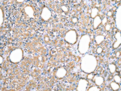 The image on the left is immunohistochemistry of paraffin-embedded Human thyroid cancer tissue using the antibody Antibody) at dilution 1/35, on the right is treated with fusion protein. (Original magnification: ×200)Rabbit anti-Human VAPA Polyclonal Antibody