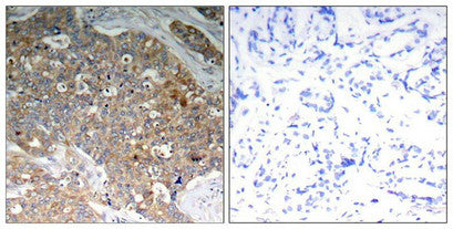 Immunohistochemical analysis of paraffin-embedded human breast carcinoma tissue using GSK3α/β(Phospho-Tyr279/216) Antibody (left) or the same antibody preincubated with blocking peptide (right).Rabbit anti-Human GSK3A/GSK3B Polyclonal Antibody