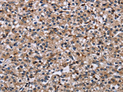 The image on the left is immunohistochemistry of paraffin-embedded Human prostate cancer tissue using IPO4 Antibody(IPO4 Antibody) at dilution 1/50, on the right is treated with fusion protein. (Original magnification: ×200)