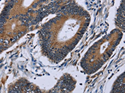 The image on the left is immunohistochemistry of paraffin-embedded Human colon cancer tissue using the antibody Antibody) at dilution 1/50, on the right is treated with fusion protein. (Original magnification: ×200)