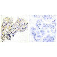 Immunohistochemical analysis of paraffin-embedded human breast carcinoma tissue using HSP90B (Ab-254) antibody.Rabbit anti-Human HSP90AB1 Polyclonal Antibody
