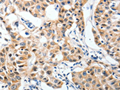 The image on the left is immunohistochemistry of paraffin-embedded Human lung cancer tissue using P2RY6 Antibody(P2RY6 Antibody) at dilution 1/40, on the right is treated with synthetic peptide. (Original magnification: ×200)Rabbit anti-Human P2RY6 Polyclonal Antibody