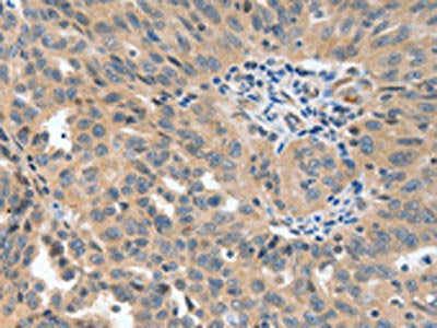 The image on the left is immunohistochemistry of paraffin-embedded Human ovarian cancer tissue using the antibody Antibody) at dilution 1/40, on the right is treated with synthetic peptide. (Original magnification: ×200)Rabbit anti-Human P2RY6 Polyclonal Antibody