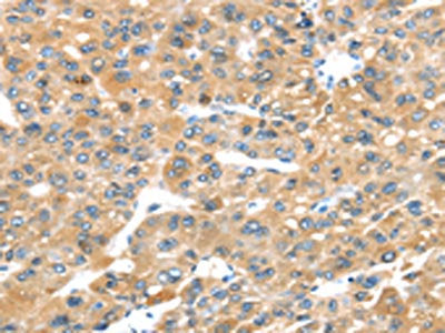 The image on the left is immunohistochemistry of paraffin-embedded Human liver cancer tissue using the antibody Antibody) at dilution 1/30, on the right is treated with synthetic peptide. (Original magnification: ×200)Rabbit anti-Human P2RY2 Polyclonal Antibody