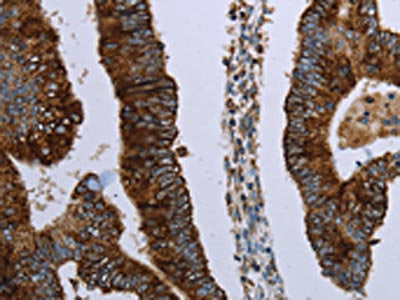 The image on the left is immunohistochemistry of paraffin-embedded Human colon cancer tissue using HMGCL Antibody(HMGCL Antibody) at dilution 1/30, on the right is treated with fusion protein. (Original magnification: ×200)Rabbit anti-Human HMGCL Polyclonal Antibody