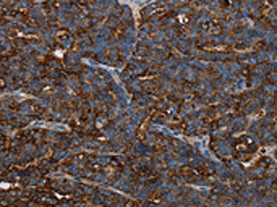 The image on the left is immunohistochemistry of paraffin-embedded Human ovarian cancer tissue using the antibody Antibody) at dilution 1/30, on the right is treated with fusion protein. (Original magnification: ×200)Rabbit anti-Human HMGCL Polyclonal Antibody