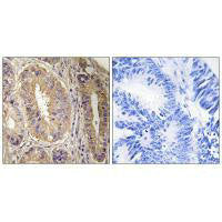 Immunohistochemistry analysis of paraffin-embedded human colon carcinoma tissue, using FAK (Ab-843) antibody.Rabbit anti-Human PTK2 Polyclonal Antibody