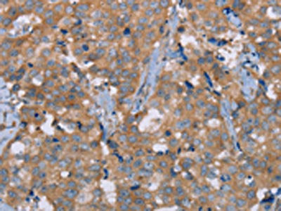 The image on the left is immunohistochemistry of paraffin-embedded Human breast cancer tissue using the antibody Antibody) at dilution 1/30, on the right is treated with synthetic peptide. (Original magnification: ×200)Rabbit anti-Human NRG3 Polyclonal Antibody