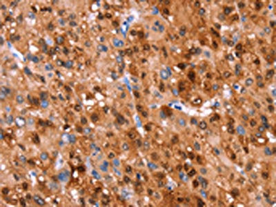 The image on the left is immunohistochemistry of paraffin-embedded Human liver cancer tissue using GH1 Antibody(GH1 Antibody) at dilution 1/40, on the right is treated with synthetic peptide. (Original magnification: ×200)Rabbit anti-Human GH1 Polyclonal Antibody