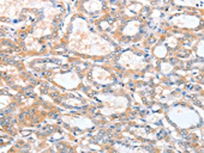 The image on the left is immunohistochemistry of paraffin-embedded Human thyroid cancer tissue using ACY3 Antibody(ACY3 Antibody) at dilution 1/25, on the right is treated with fusion protein. (Original magnification: ×200)Rabbit anti-Human ACY3 Polyclonal Antibody