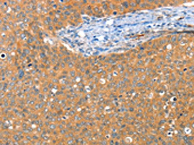 The image on the left is immunohistochemistry of paraffin-embedded Human cervical cancer tissue using the antibody Antibody) at dilution 1/25, on the right is treated with fusion protein. (Original magnification: ×200)