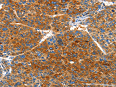 The image on the left is immunohistochemistry of paraffin-embedded Human liver cancer tissue using VWA5A Antibody(VWA5A Antibody) at dilution 1/60, on the right is treated with fusion protein. (Original magnification: ×200)Rabbit anti-Human VWA5A Polyclonal Antibody