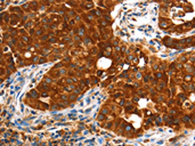 The image on the left is immunohistochemistry of paraffin-embedded Human lung cancer tissue using the antibody Antibody) at dilution 1/60, on the right is treated with fusion protein. (Original magnification: ×200)Rabbit anti-Human VWA5A Polyclonal Antibody