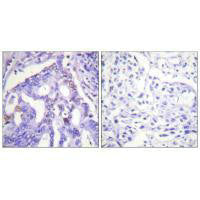 Immunohistochemistry analysis of paraffin-embedded human lung carcinoma tissue using PIAS4 antibody.Rabbit anti-Human PIAS4 Polyclonal Antibody