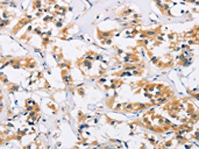 The image is immunohistochemistry of paraffin-embedded Human thyroid cancer tissue using AXIN2 Antibody(AXIN2 Antibody) at dilution 1/20. (Original magnification: ×200)Rabbit anti-Human AXIN2 Polyclonal Antibody