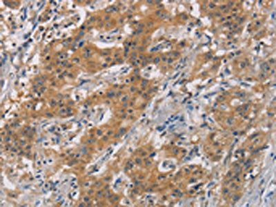 The image is immunohistochemistry of paraffin-embedded Human gastic cancer tissue using the antibody Antibody) at dilution 1/20. (Original magnification: ×200)