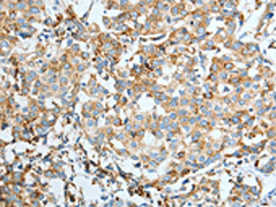 The image on the left is immunohistochemistry of paraffin-embedded Human breast cancer tissue using ASAH1 Antibody(ASAH1 Antibody) at dilution 1/50, on the right is treated with fusion protein. (Original magnification: ×200)Rabbit anti-Human ASAH1 Polyclonal Antibody