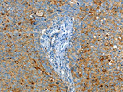 The image on the left is immunohistochemistry of paraffin-embedded Human cervical cancer tissue using the antibody Antibody) at dilution 1/50, on the right is treated with fusion protein. (Original magnification: ×200)Rabbit anti-Human ASAH1 Polyclonal Antibody