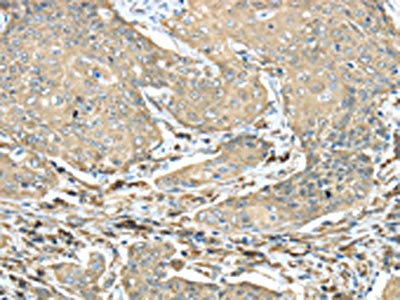 The image on the left is immunohistochemistry of paraffin-embedded Human cervical cancer tissue using NME2 Antibody(NME2 Antibody) at dilution 1/40, on the right is treated with synthetic peptide. (Original magnification: ×200)Rabbit anti-Human NME2 Polyclonal Antibody