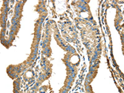 The image on the left is immunohistochemistry of paraffin-embedded Human thyroid cancer tissue using the antibody Antibody) at dilution 1/40, on the right is treated with synthetic peptide. (Original magnification: ×200)Rabbit anti-Human NME2 Polyclonal Antibody