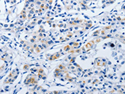 The image on the left is immunohistochemistry of paraffin-embedded Human lung cancer tissue using BPIFB3 Antibody(BPIFB3 Antibody) at dilution 1/50, on the right is treated with synthetic peptide. (Original magnification: ×200)