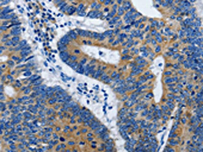 The image on the left is immunohistochemistry of paraffin-embedded Human colon cancer tissue using the antibody Antibody) at dilution 1/50, on the right is treated with synthetic peptide. (Original magnification: ×200)