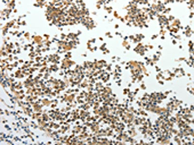 The image on the left is immunohistochemistry of paraffin-embedded Human tonsil tissue using RRM1 Antibody(RRM1 Antibody) at dilution 1/15, on the right is treated with fusion protein. (Original magnification: ×200)Rabbit anti-Human RRM1 Polyclonal Antibody