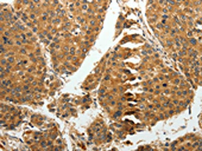 The image on the left is immunohistochemistry of paraffin-embedded Human liver cancer tissue using the antibody Antibody) at dilution 1/15, on the right is treated with fusion protein. (Original magnification: ×200)Rabbit anti-Human RRM1 Polyclonal Antibody
